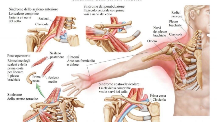 La cervicobrachialgia