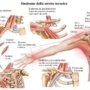 La cervicobrachialgia